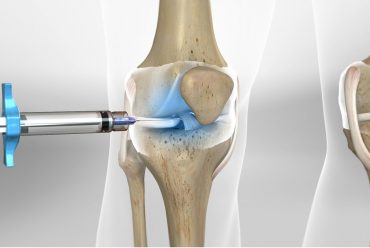 INTRA ARTICULER INJECTION