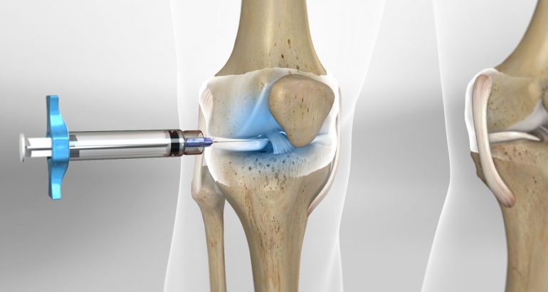 INTRA ARTICULER INJECTION